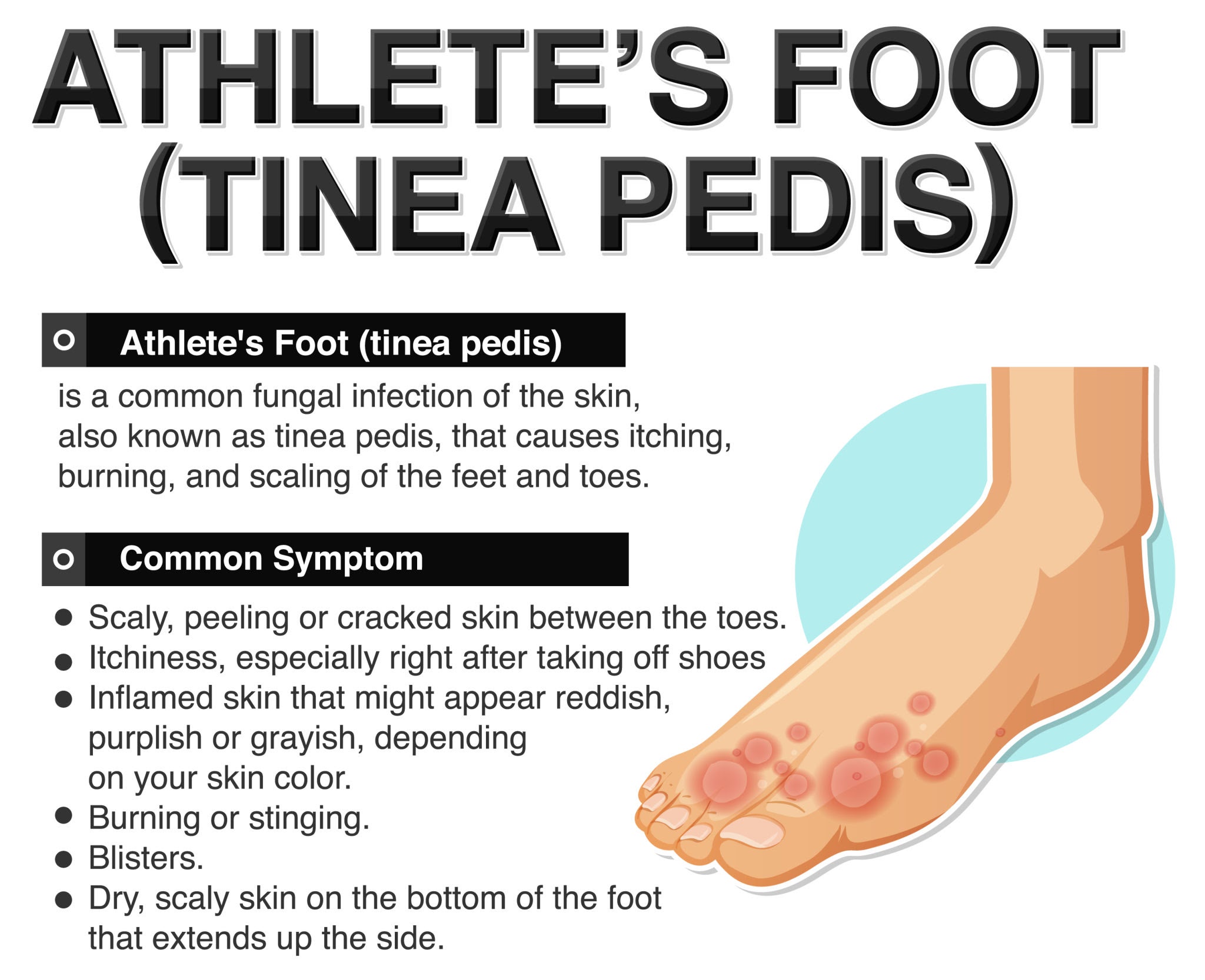 Informative poster of Athlete foot